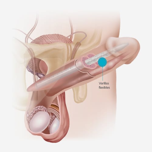 diagram of penile implant