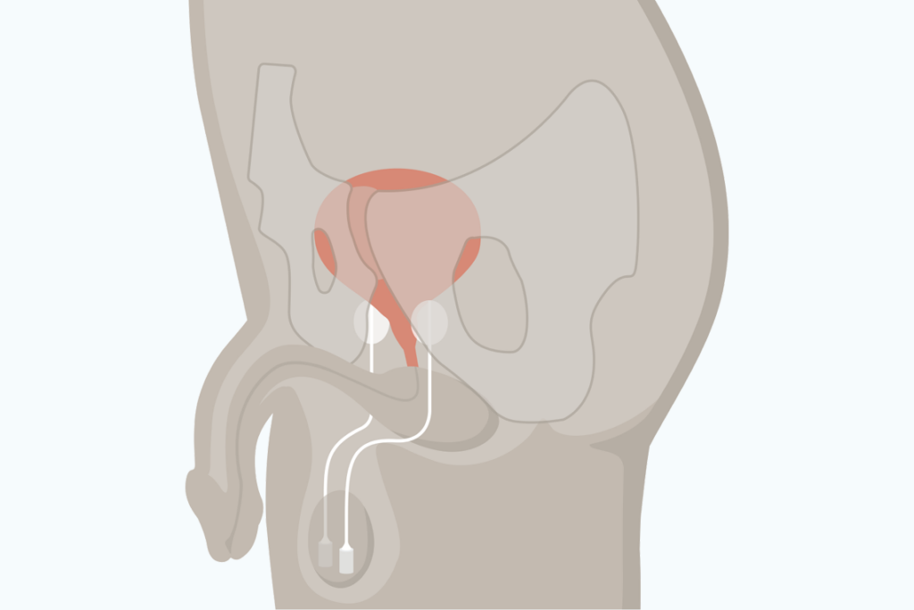cpmh-balloon_SUI-final