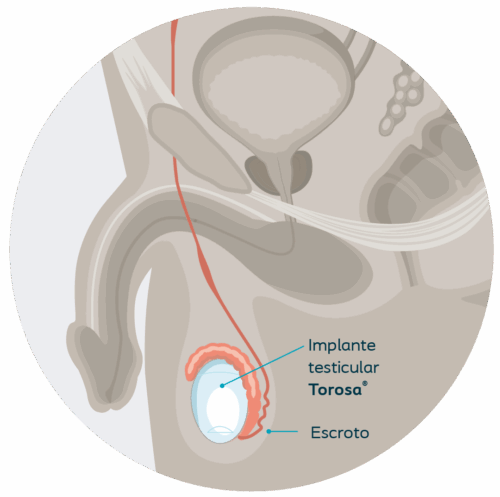 tr-testicular implants-diagram-2