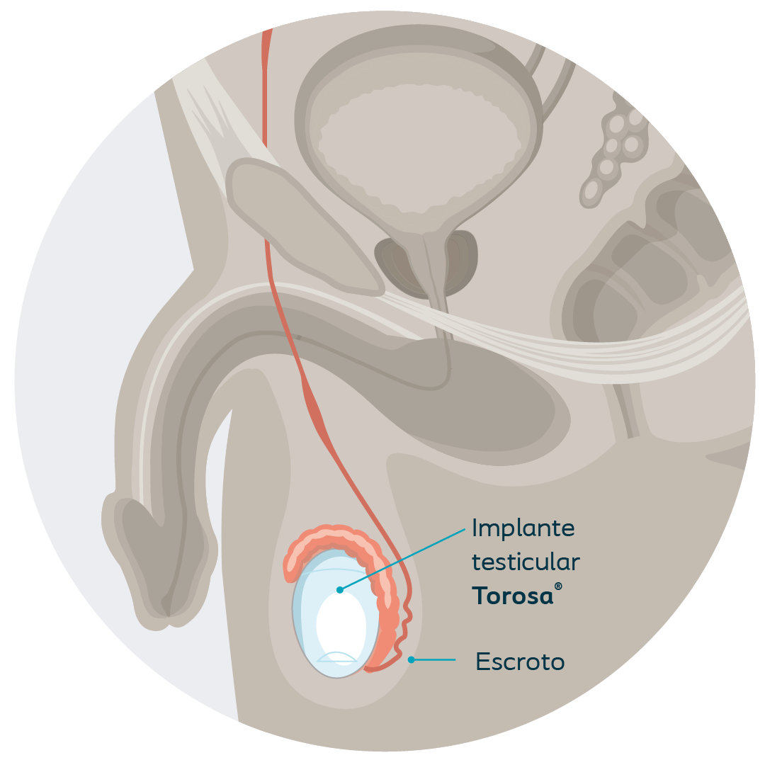 tr-testicular implants-diagram-2